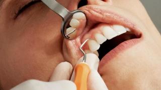 Създадоха нанороботи за почистване на зъби