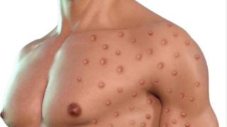 Два случая на маймунска шарка са потвърдени в България